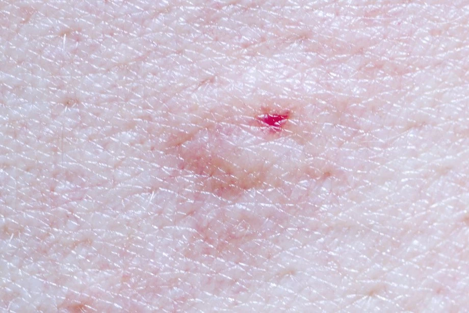 bee sting