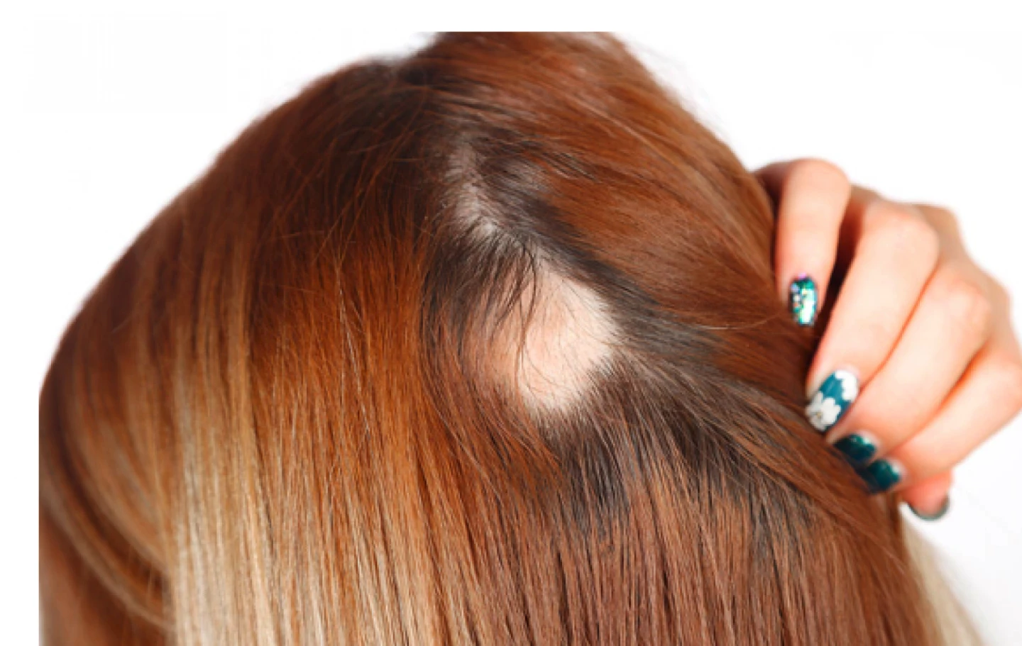 Alopecia
