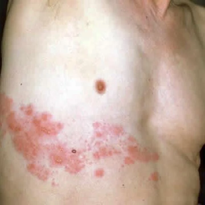 Shingles 03