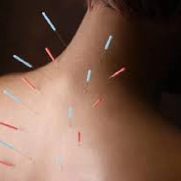 acupuncture