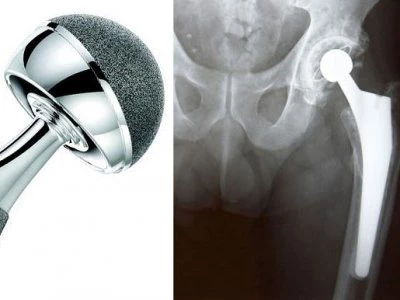 hip replacement